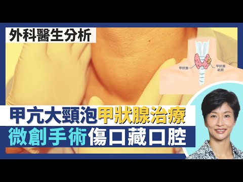 甲亢大頸泡甲狀腺治療｜圖解甲狀腺結節射頻消融術 甲狀腺微創手術傷口藏口腔內！眼凸病人藥物治療後復發不能飲碘水治療需做手術？甲狀腺疾病分功能性vs結構性問題｜王建芳醫生 何柏堅外科醫生｜人類健康研究所