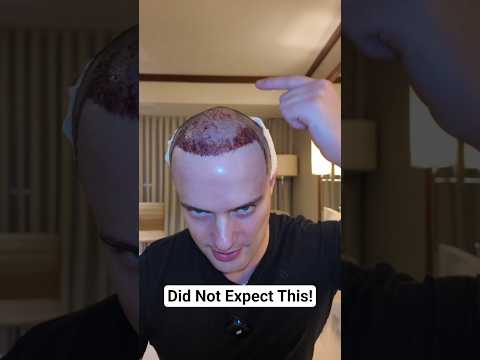 First Night After Hair Transplant!