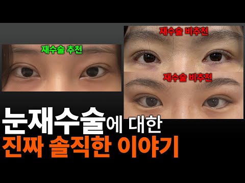 눈재수술 원장의 눈재수술에 대해 너무 현실적인 이야기