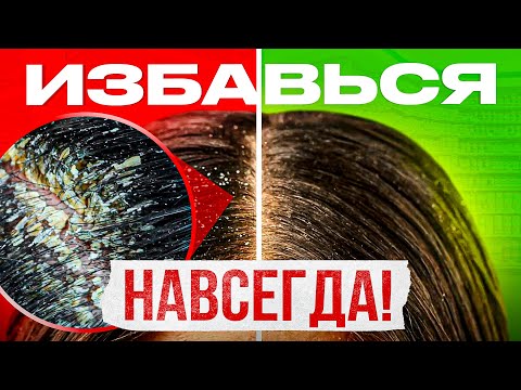 Dandruff. 5 Causes of Dandruff. Get Rid of Dandruff Forever!