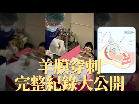 【玉兔娘娘】羊膜穿刺完整過程全紀錄大公開！其實沒有你想像中的可怕。