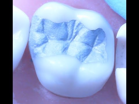 Class II Amalgam Restoration 1 | Operative Dentistry