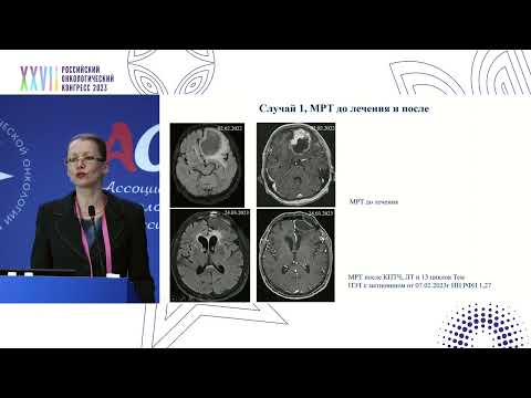 Применение секвенирования нового поколения в диагностике, прогнозе и лечении первичных опухолей ЦНС