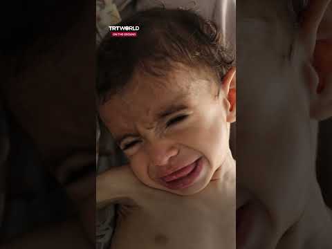 Born into hunger: Zakaria’s struggle with malnutrition in Gaza