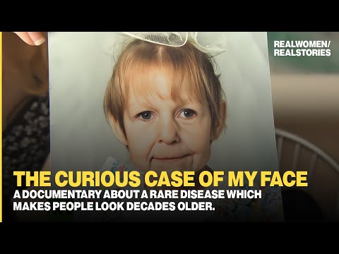 Dermatochalasis: A rare disease makes people look decades older (Documentary)