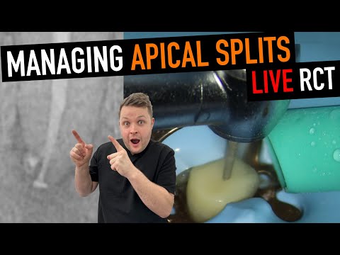 T-Mode Magic! Deep Apical Split & Ledge Bypass in Lower Premolar