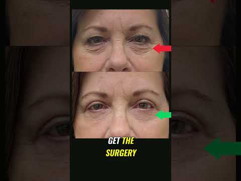 Loose Eyelid Tendons: Causes and Fixes Explained Simply #shorts