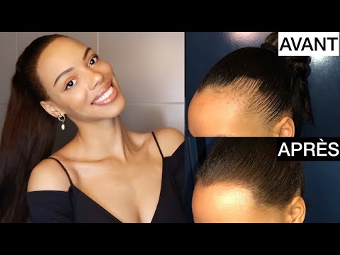 S.O.S: Front dégarni | Comment faire pousser les cheveux & Astuce pour masquer l'alopécie !