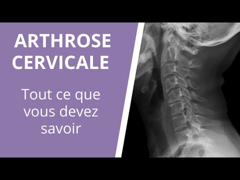 Tout ce que vous devez savoir sur l'arthrose cervicale : causes, symptômes et traitements
