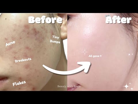 How to ACTUALLY treat ALL your skin problems ✨🍒 || *no cap