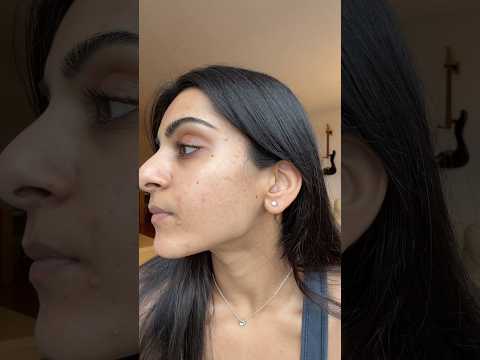 I document my skin journey w/ progress pics on my skincare app Clear #acne #skincare #derm #spiro
