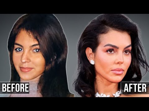Georgina Rodríguez: Plastic Surgery Secrets Behind Cristiano Ronaldo’s Billion-Dollar Partner