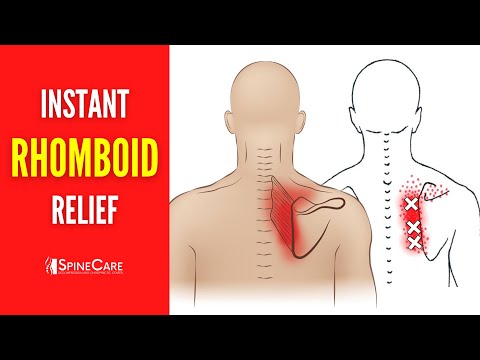 How to Fix Rhomboid Pain FOR GOOD