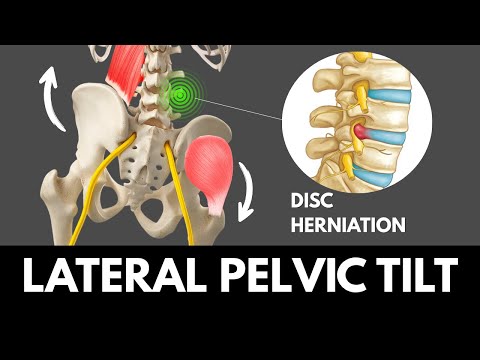 Truth Behind Your Lateral Pelvic Tilt and How to Fix it Fast