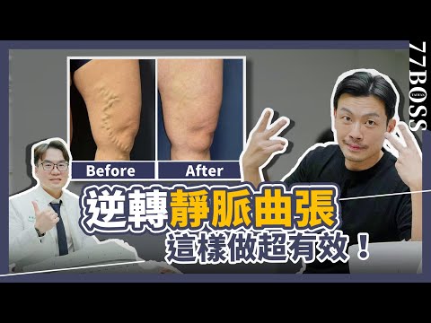靜脈曲張不只醜，嚴重居然會致命！？權威名醫教你如何逆轉，這樣做，超有效！？feat.張學倫醫師【77老大】