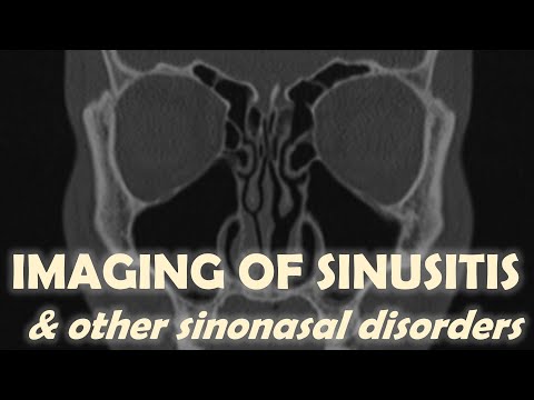 Imaging of Sinusitis (and other sinonasal disorders)