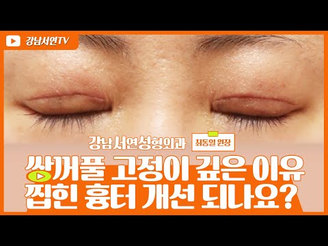성형탐구 I 쌍꺼풀 고정이 깊은 이유, 찝힌 흉터 개선할 수 있나요?