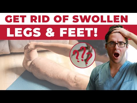 Lymphedema Treatment [How to Get Rid of Swollen Feet, Ankles & Legs]