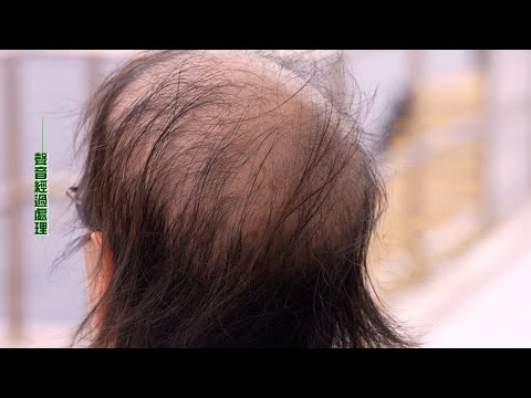 東張西望丨有片丨貪靚女事主皮膚診所治療「鬼剃頭」卻變禿頭  怒控：我36歲被搞到似66歲｜鬼剃頭｜禿頭｜類固醇搽藥｜嚴重脫髮｜俞可程