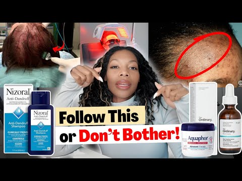 Before You Fly to Turkey for a Hair Transplant… Follow These Steps to Get Your Edges Back