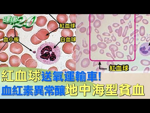 紅血球送氧運輸車！ 血紅素異常釀地中海型貧血 健康2.0