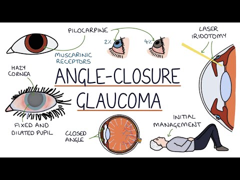 Understanding Acute Angle Closure Glaucoma