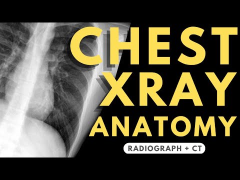 Chest X-ray Anatomy | Radiology anatomy part 1 prep | How to interpret a chest X-ray