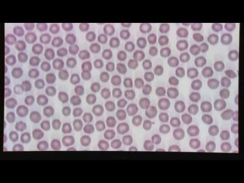 Blood Smear Evaluation