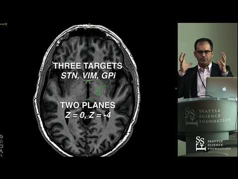 DBS for Movement Disorders - Francisco Ponce, MD, FAANS