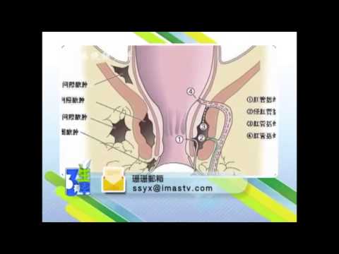 Anal Fistula 中文 三生有幸   肛瘘 FULL