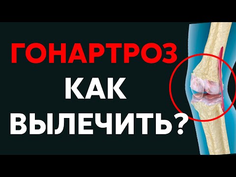 Гонартроз, артроз коленного сустава | Доктор Черкасов