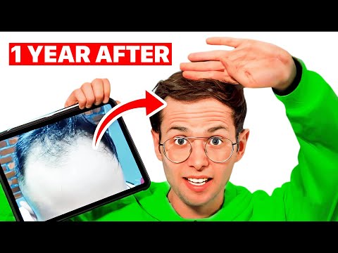 How I Fixed My Balding (One Year After Surgery) | Surgeon Reacts