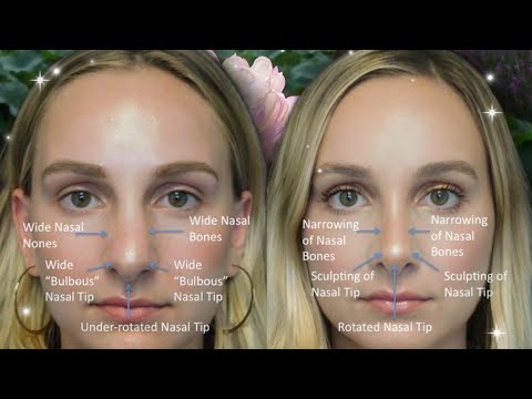 𓏵 𝓑ULBOUS NOSE TIP REDUCTION 𓏵💉👃🏽 tiny, feminine nose tip procedure ⊹