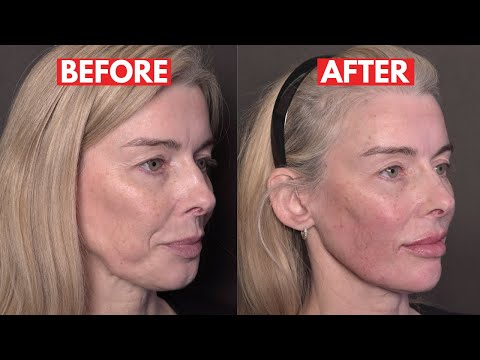 How to minimise jowls for your patients! (It's not JUST about injection technique)