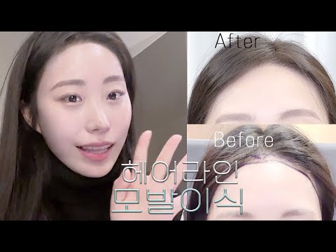 헤어라인 모발이식 vlog : 수술 당일~3주차 관리&샴푸방법