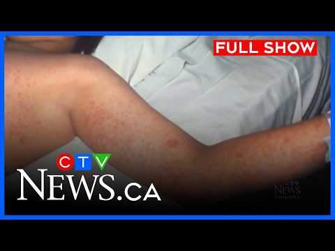 Manitoba records 170 measles cases in February | CTV News Winnipeg at Six for Mar. 9, 2026