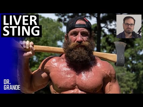 'Alpha Male' Ancestral Lifestyle Bodybuilder Was Full of More than Liver | Liver King Case Analysis