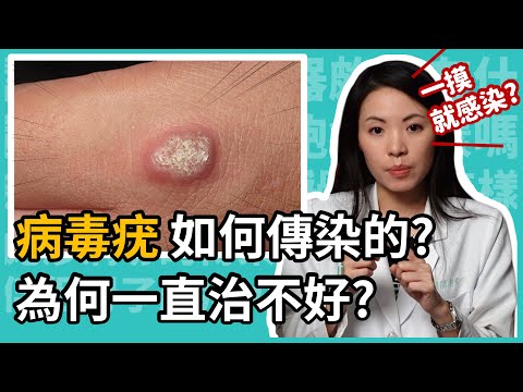 病毒疣是甚麼，為甚麼一直治療不好？病毒疣、菜花、雞眼，皮膚科林昀萱醫師，一招教你如何分辨。