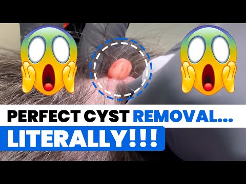 PERFECT CYST REMOVAL...LITERALLY!!!