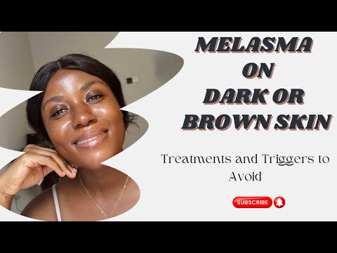Melasma Treatment? Melasma: Causes, Treatments & More for Dark/Brown Skin