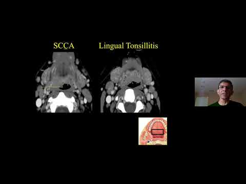 Anatomy & Pathology of the Oral Cavity & Oropharynx Dr Suresh Mukherji - MRI Online Noon Conference