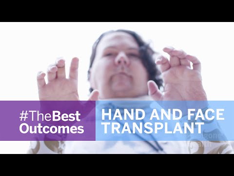 Face and Double Hand Transplant Journey: Joe Dimeo's Story