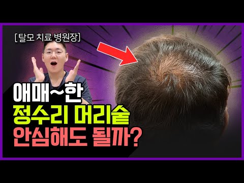 탈모 유전자가 없더라도 정수리를 조심해야 합니다! 정수리 탈모 원인과 그 치료법!