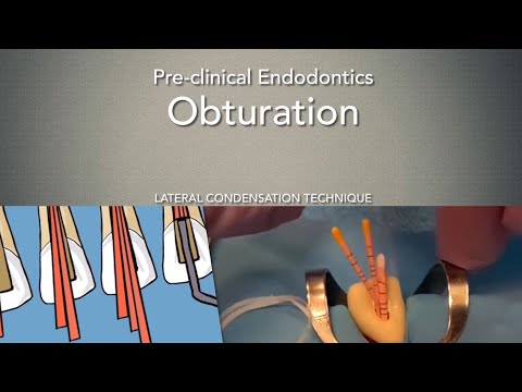 Obturation (Lateral Condensation Technique)