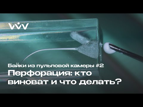 Перфорация в канале зуба: что с ней делать? | Пломбирование каналов