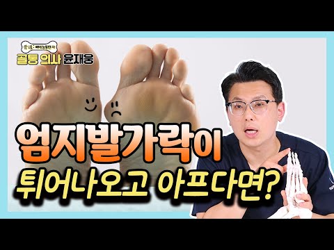엄지발가락이 휘는 무지 외반증 말끔하게 고치는 방법 - 골통 의사 윤재웅 #23 무지외반증