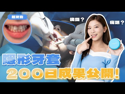 隱形牙套200日親身實測Q&A 🦷箍牙過程會很痛嗎？哪些人不適合戴？費用、優缺點全公開 | Zenyum【Pinky Talks】