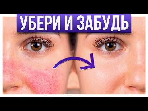 ЭТО поможет ПОБОРОТЬ розацеа! / Как избавиться от РОЗАЦЕА за месяц: Реальные методы лечения