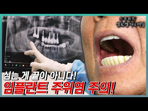 임플란트 관리 잘못하면 생기는 일들 🦷 마저 뽑히기 싫으면 관리만이 살 길! 😱 임플란트 주위염 주의염! | KBS 231213 방송