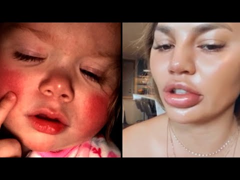 These People had Unusual Allergic Reactions